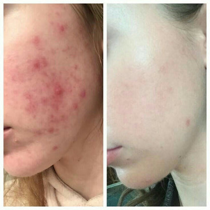 Peau du visage avec boutons et rougeurs d’acné, résultat après application