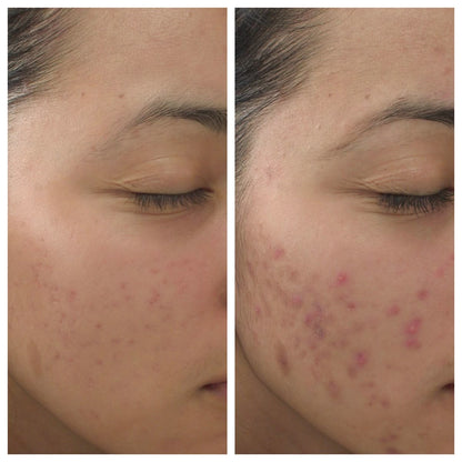 Peau du visage avec légères taches et boutons d’acné, avant/après rapproché
